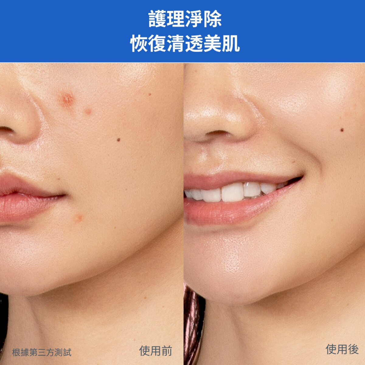 FOREO 至臻煥膚節日套裝 - 艾絲帕達-藍光美顏凈膚儀  F1184