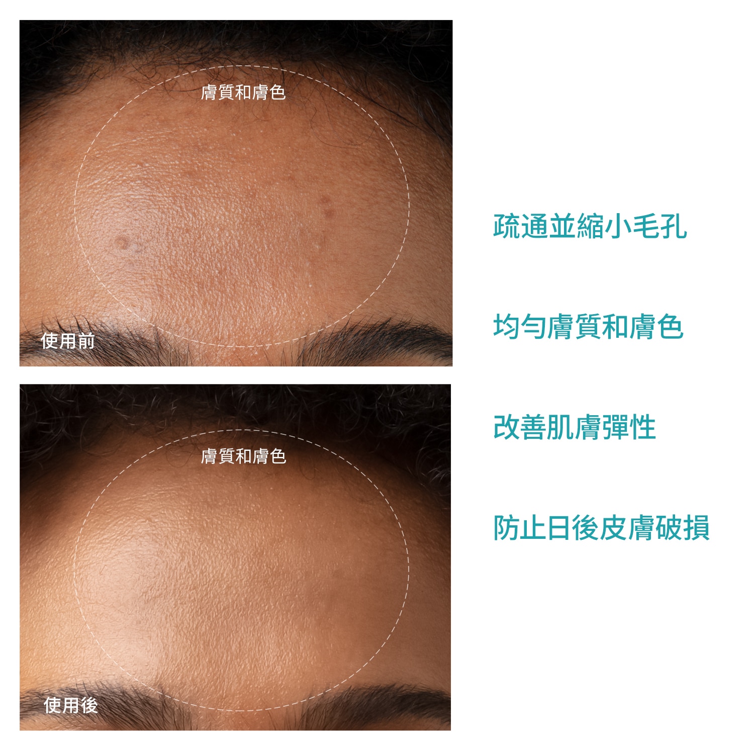 FOREO KIWI™ 藍光去黑頭毛孔吸塵器 F1948