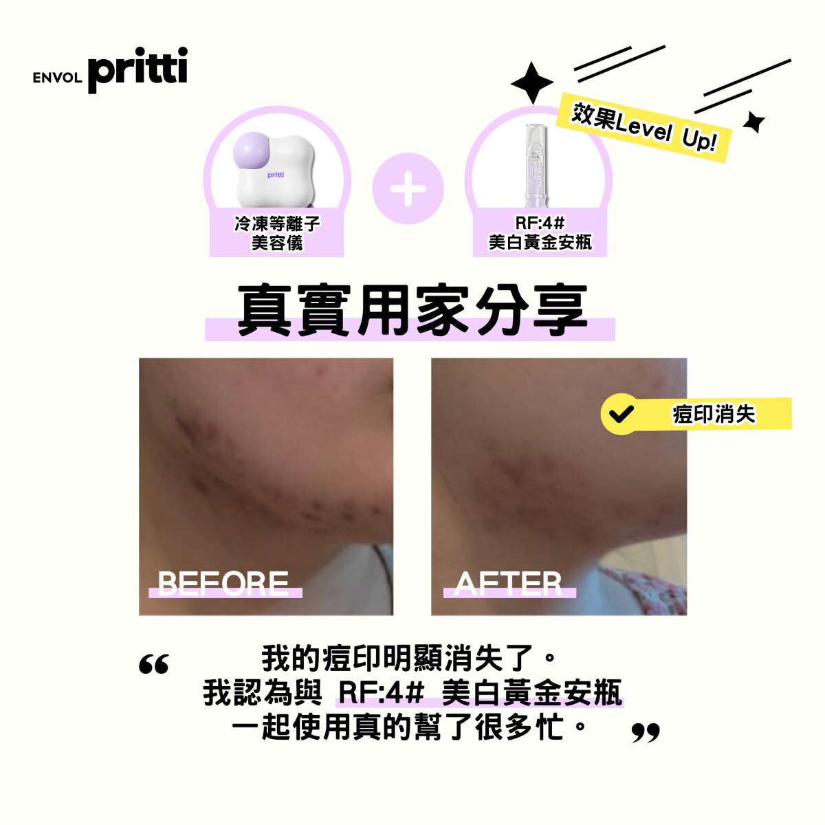 OTHERS 其他 Pritti 冷凍等離子機 頸紋寶 粉紅色 香港行貨